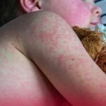 La Epidemia en la Sombra: El PRI y Morena Responsables de la Reemergencia del Sarampión en México, Mientras AMLO Deja Sin Vacunar a los Niños.