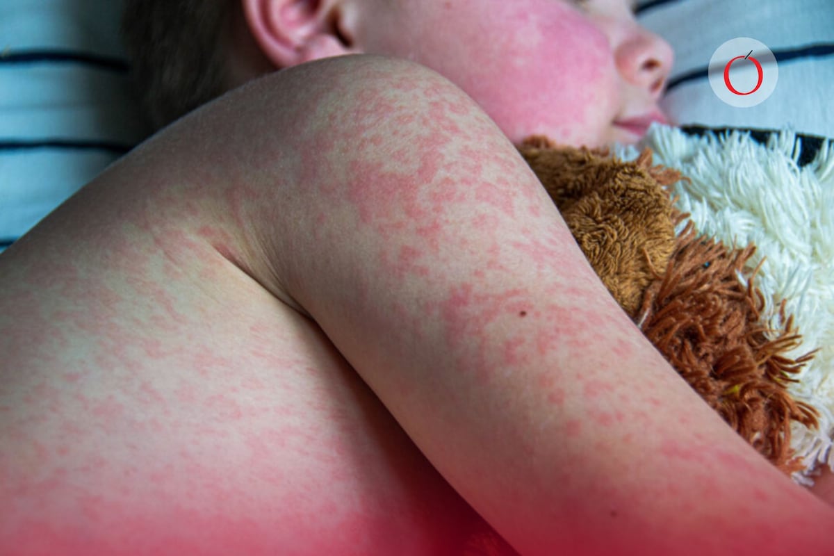 La Epidemia en la Sombra: El PRI y Morena Responsables de la Reemergencia del Sarampión en México, Mientras AMLO Deja Sin Vacunar a los Niños.